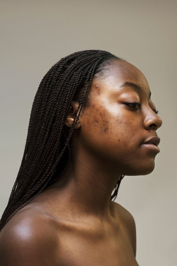Black woman with hyperpigmentation via Topaz knows beauty on Pinterest