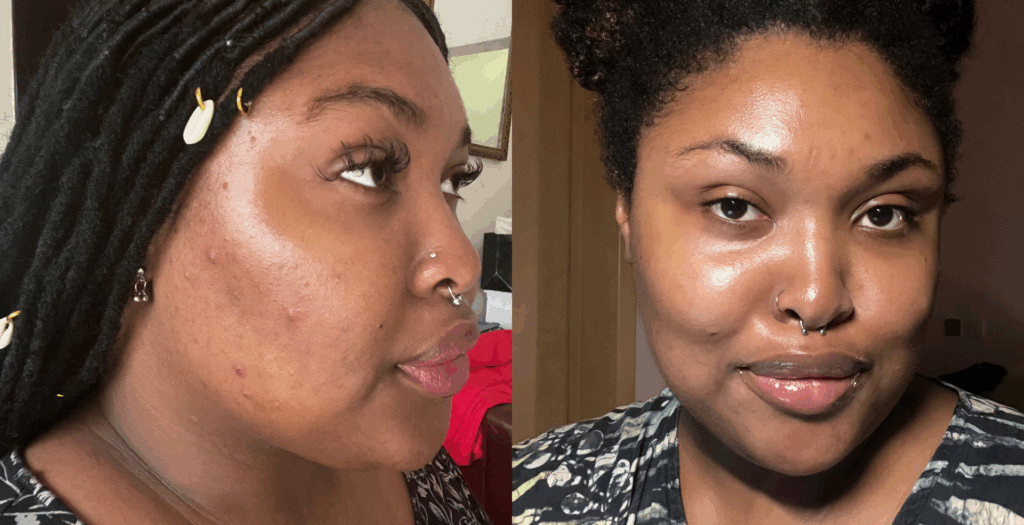 A before and after of the effects of a skin cycling routine. The image to the left shows a ¾ profile with acne, redness, puffiness, and texture. The image to the right shows a clearer, even complexion, with no acne, a soft glow, and no redness.