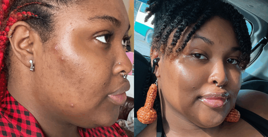 A before and after of the effects of a skin cycling routine. The image to the left shows a ¾ profile with acne, redness, puffiness, and texture. The image to the right shows a clearer, even complexion, with no acne, a soft glow, and no redness.