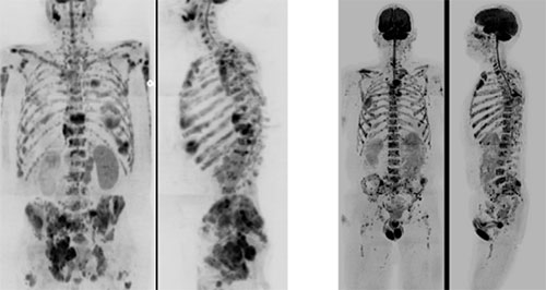 Maximum Intensity Projections of Whole body b800 DWI