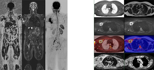 Invasive Lobular Cancer