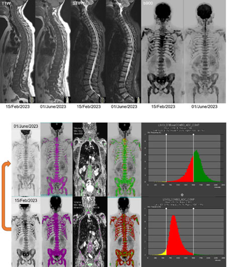 Metastatic breast cancer with bone, node, and liver disease