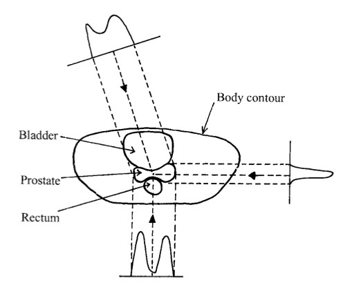 Prostate target, rectum and bladder