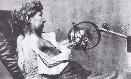 Radiotherapy of a chest wall recurrence after mastectomy 1903