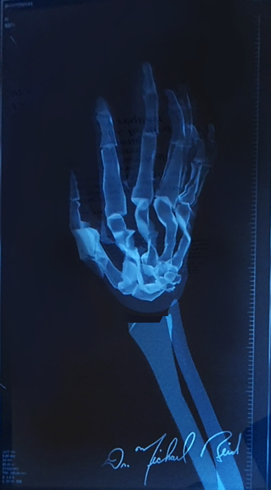 Close-up of a simulated X-ray image displayed within the exhibit at the Museum of the Jewish Community in Sabac, showing a detailed skeletal structure of a hand with a ring, reminiscent of the first X-ray photograph by Dr. Wilhelm Roentgen. The image serves as an educational homage to the early adoption of X-ray technology in Sabac and its medical pioneers.