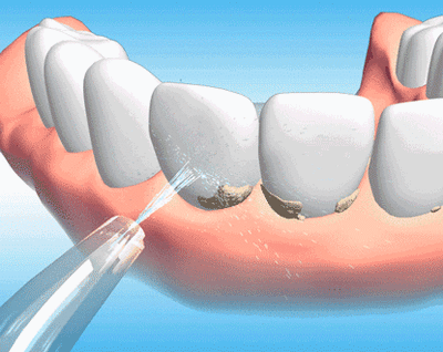 WeSmile Waterflosser Demo