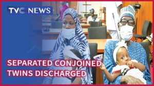 15-Month-cojoined-twins-successfully-separated-discharged