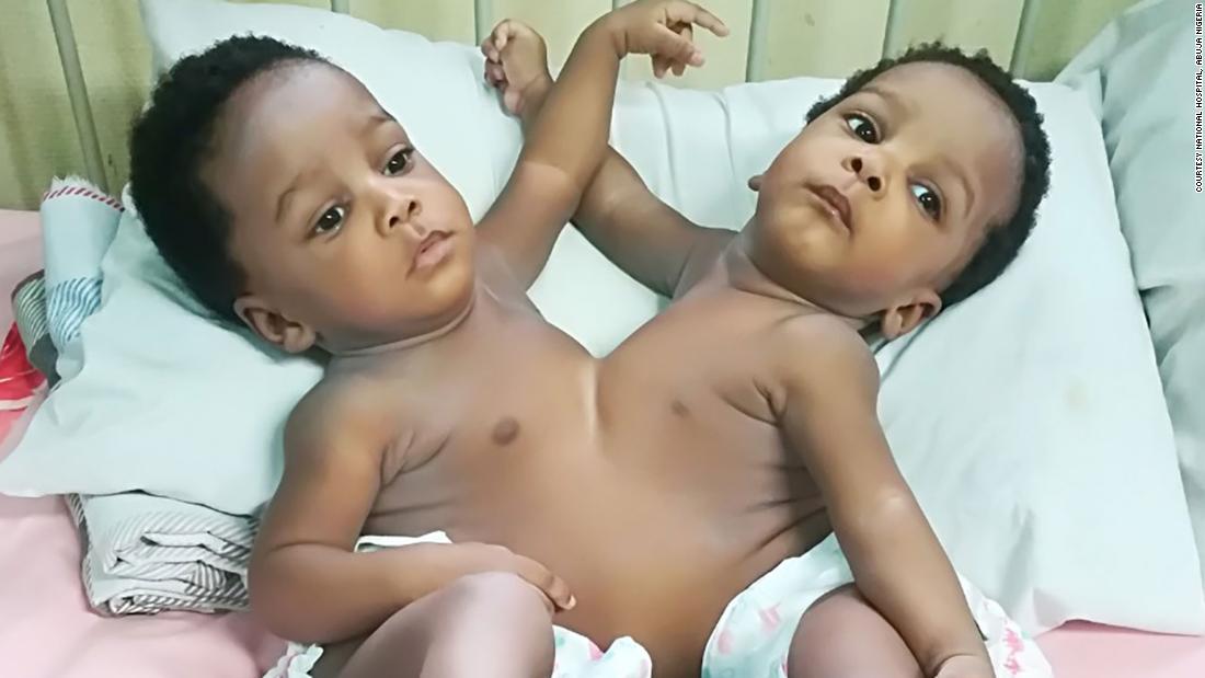 Conjoined-twins-successfully-separated-by-78-member-team-in-Abuja