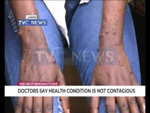 Doctors-say-Neurofibromatosis-is-not-contagious