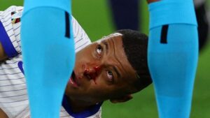 Kylian Mbappe suffers a broken nose, wear a protective mask
