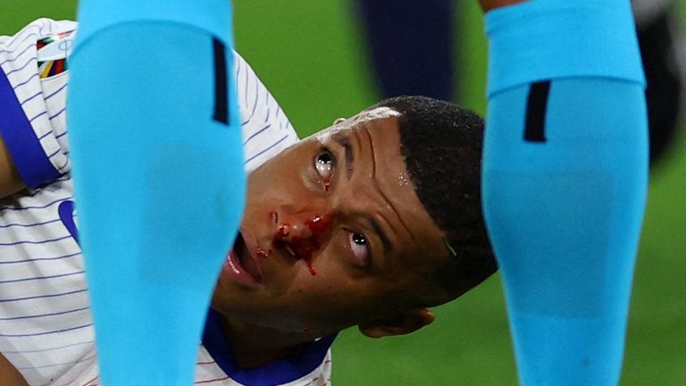 Kylian Mbappe suffers a broken nose, wear a protective mask
