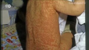 measles