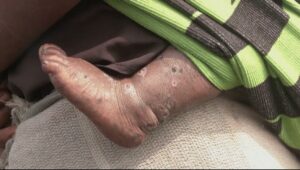 A knowledge gap could complicate the fight against mpox
