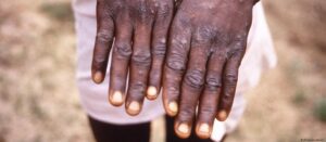 Africa mpox outbreak