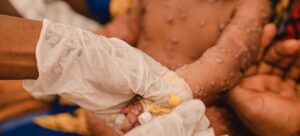 Mpox overwhelms Congo’s South Kivu province