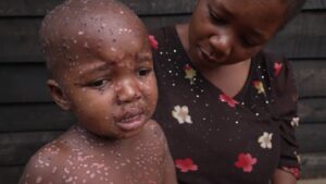 Mpox outbreak in DR Congo hits children hardest