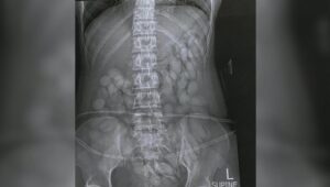 S. Africa police arrest woman with over 60 ‘drug bullets’ in stomach