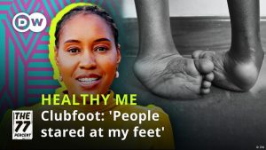 Clubfoot: ‘People always stare at my feet’