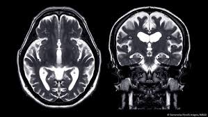 What is a concussion, and how do you treat it?