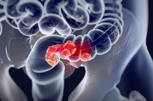 Bowel cancer rates rising in young people