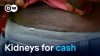 Kenya at center of global kidney trade